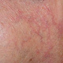 Couperose & rosacea – een gerichte aanpak