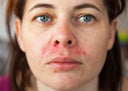 &nbsp;Dermatitis