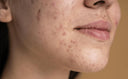 foto acné huid - The Skin Company Oostende