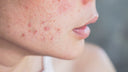&nbsp;Roaccutane huid&nbsp;
