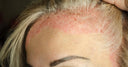 &nbsp;Psoriasis&nbsp;